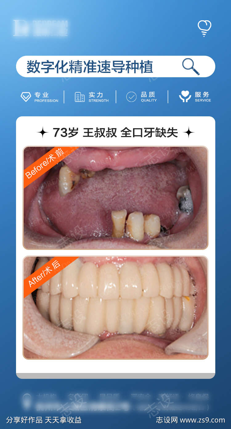 种植牙口腔案例对比海报