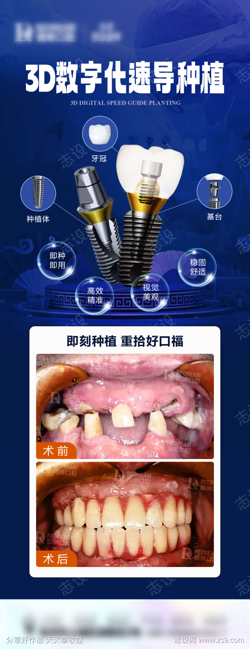 种植牙案例海报
