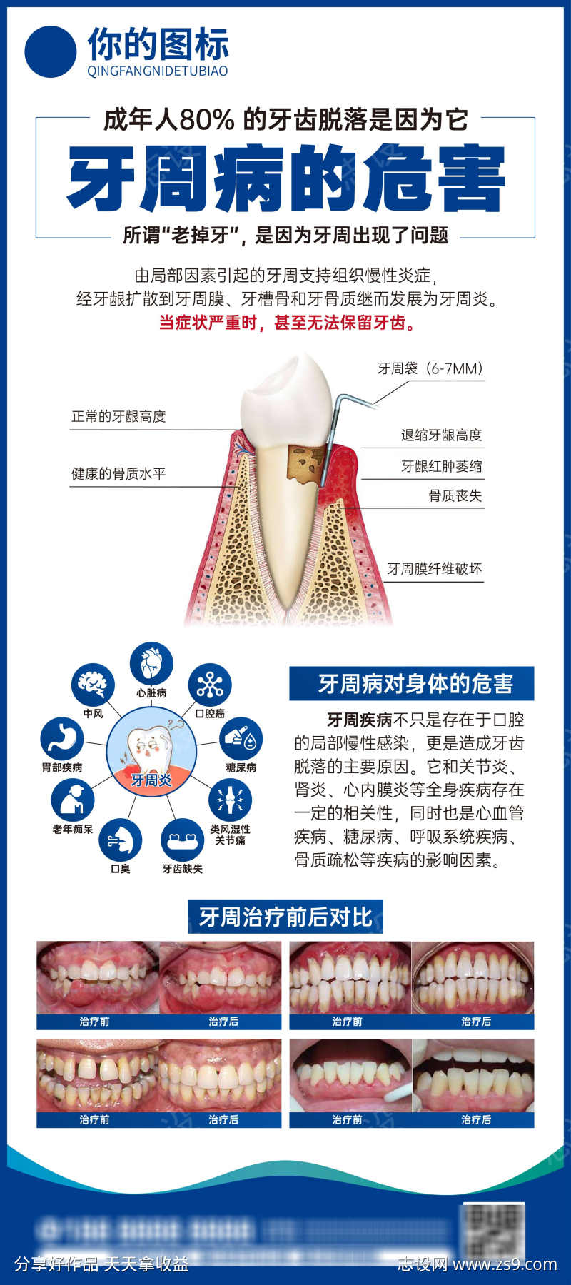 牙周活动展架