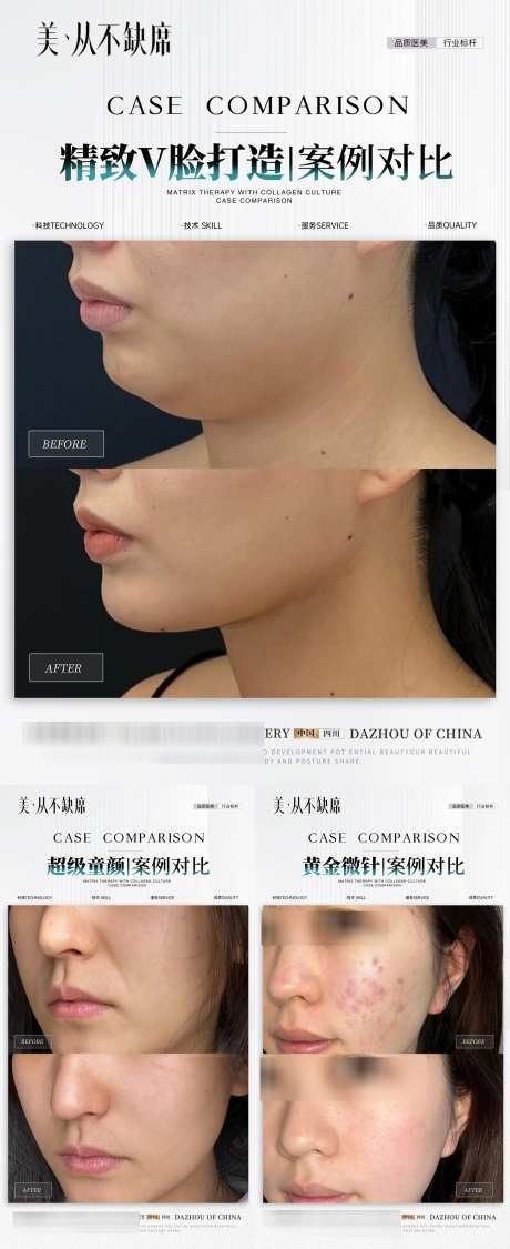 医美童颜微整V脸案例_源文件下载_23格式_1300X3180像素-面雕,体雕,对比-作品编号:2025011409382209-志设-zs9.com
