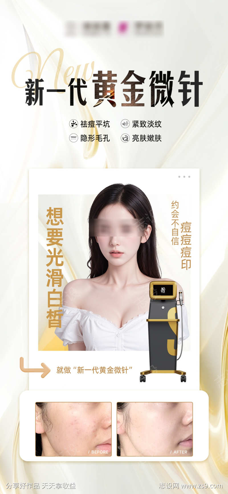新一代黄金微针案例