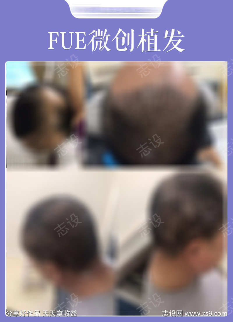 FUE植发案例海报