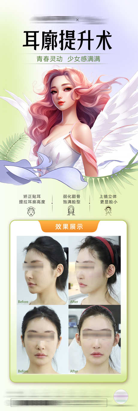 耳廓提升术海报_源文件下载_PSD格式_1077X3212像素-填充,案例,轮廓-作品编号:2025030109076111-志设-zs9.com