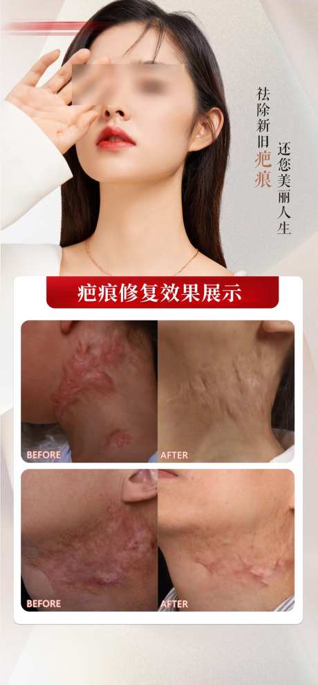 疤痕修复案例海报_源文件下载_PSD格式_1080X2330像素-美肤,海报,除疤-作品编号:2025031115251648-志设-zs9.com