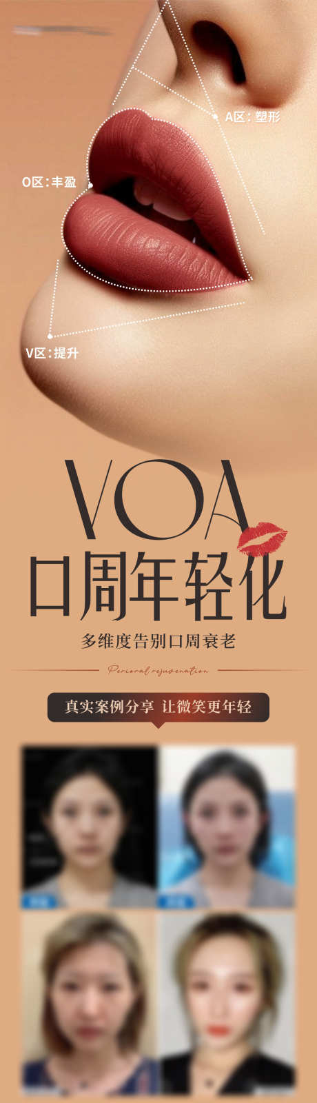 医美VOA区口周年轻化案例创意海报_源文件下载_CDR格式_1270X4732像素-唇部,嘴唇,嘴巴-作品编号:2025031213056407-志设-zs9.com