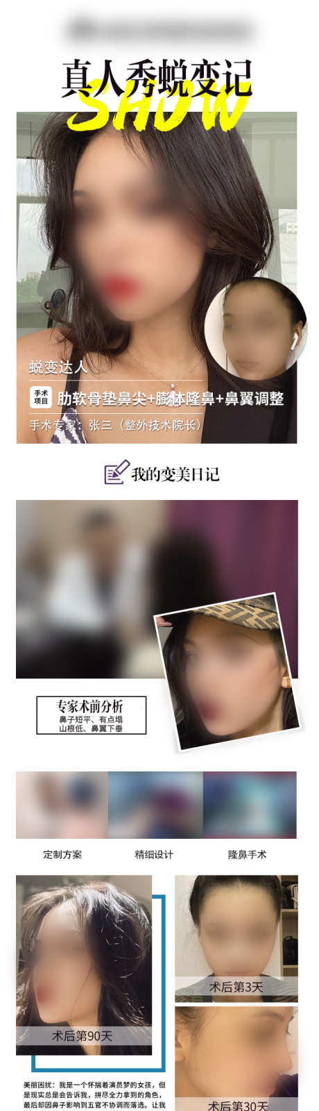模特隆鼻案例打版长图_源文件下载_PSD格式_640X2978像素-医生,介绍,医美-作品编号:2025031413328486-志设-zs9.com