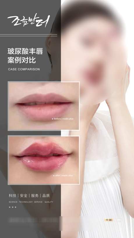 玻酿酸案例_源文件下载_PSD格式_1500X2675像素-玻酿酸,案例,微调-作品编号:2025033013121745-志设-zs9.com