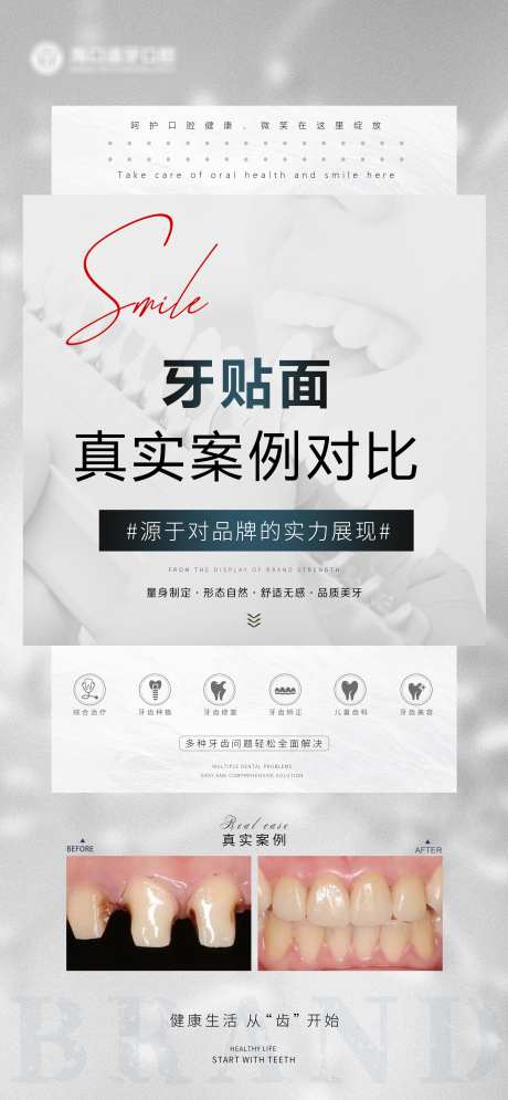 牙贴面案例对比_源文件下载_PSD格式_3543X7666像素-矫正,补牙,种植牙-作品编号:2025033013595245-志设-zs9.com