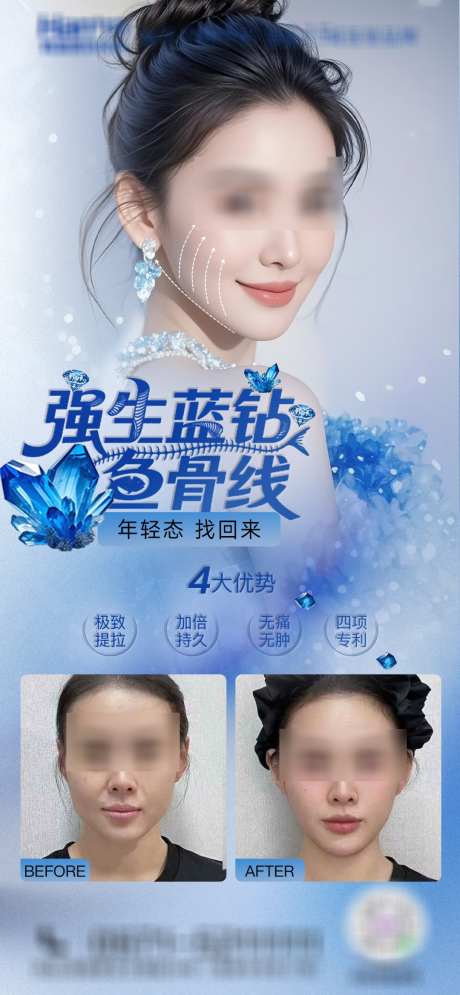 医美强生蓝钻鱼骨线