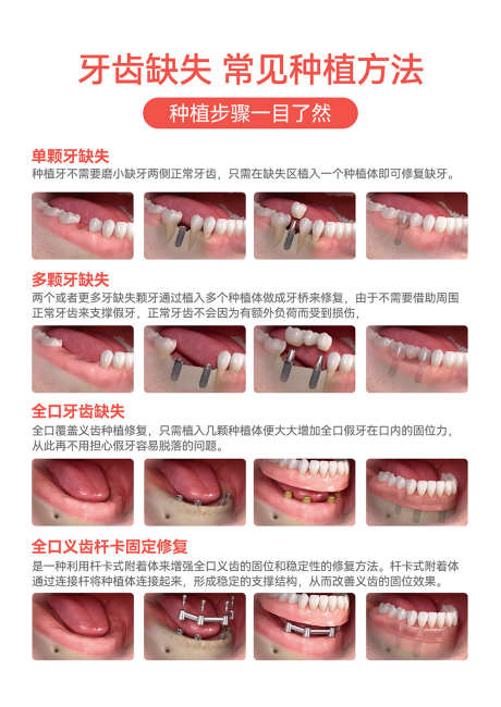 口腔牙科常见种植方式海报_源文件下载_PSD格式_2480X3508像素-种植方法,种植牙,牙科-作品编号:2025052409454687-志设-zs9.com