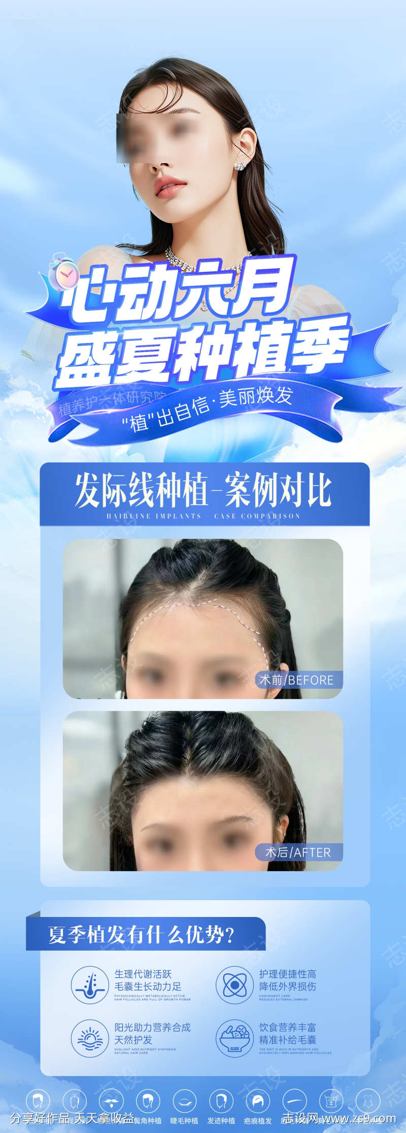 医美夏季植发案例对比海报