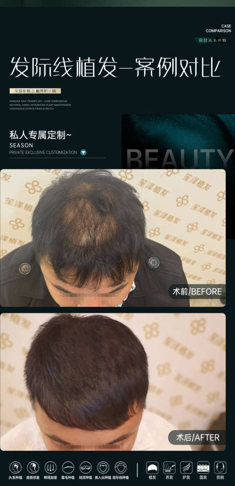 医美植发案例对比海报_源文件下载_PSD格式_2000X4126像素-案例对比,案例,植发-作品编号:2025061714348917-志设-zs9.com