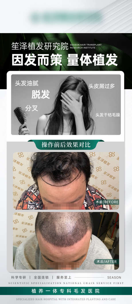 医美植发案例对比海报_源文件下载_PSD格式_1500X3442像素-案例对比,案例,植发-作品编号:2025061714407440-志设-zs9.com