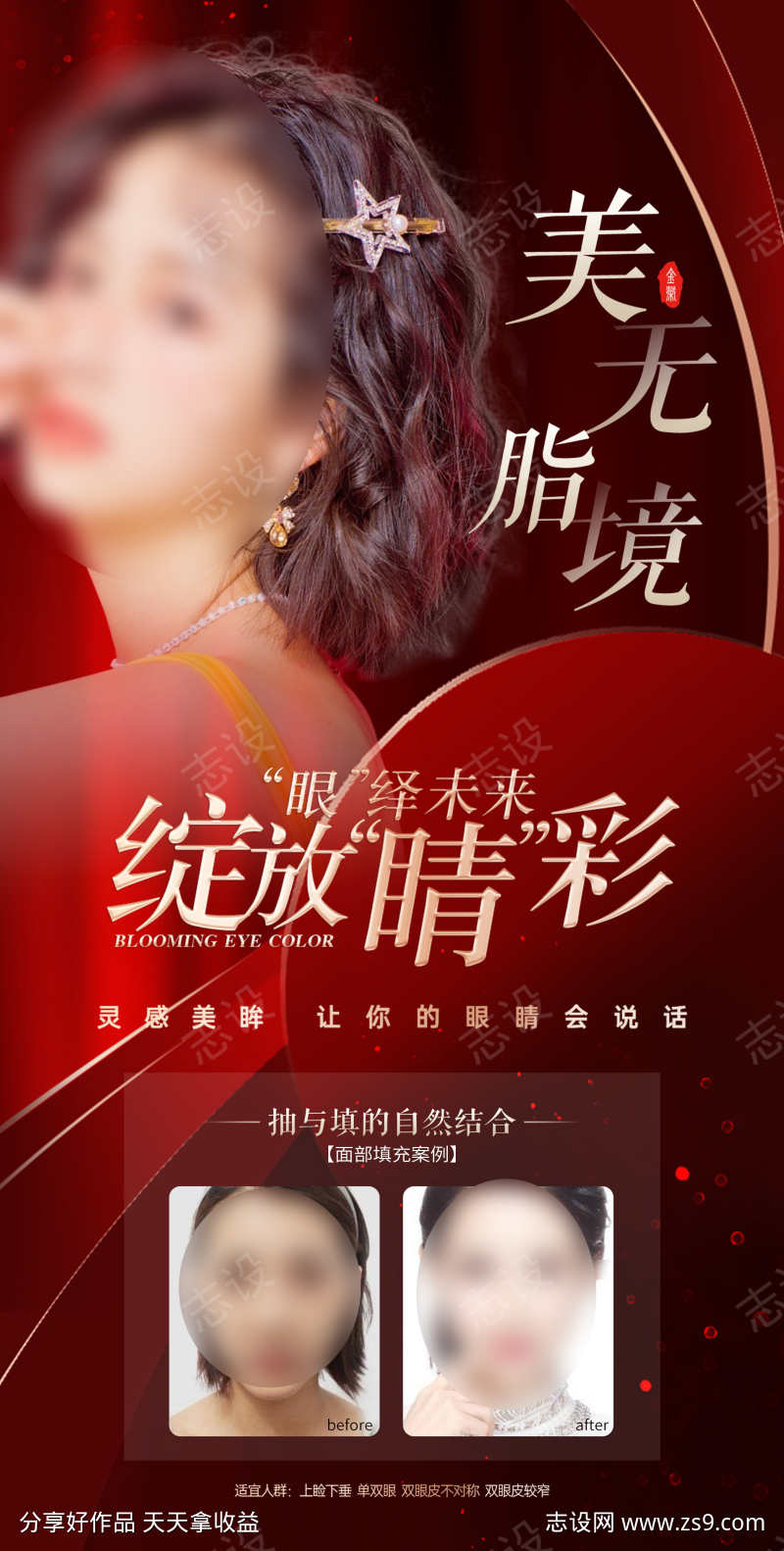 医美双眼皮案例