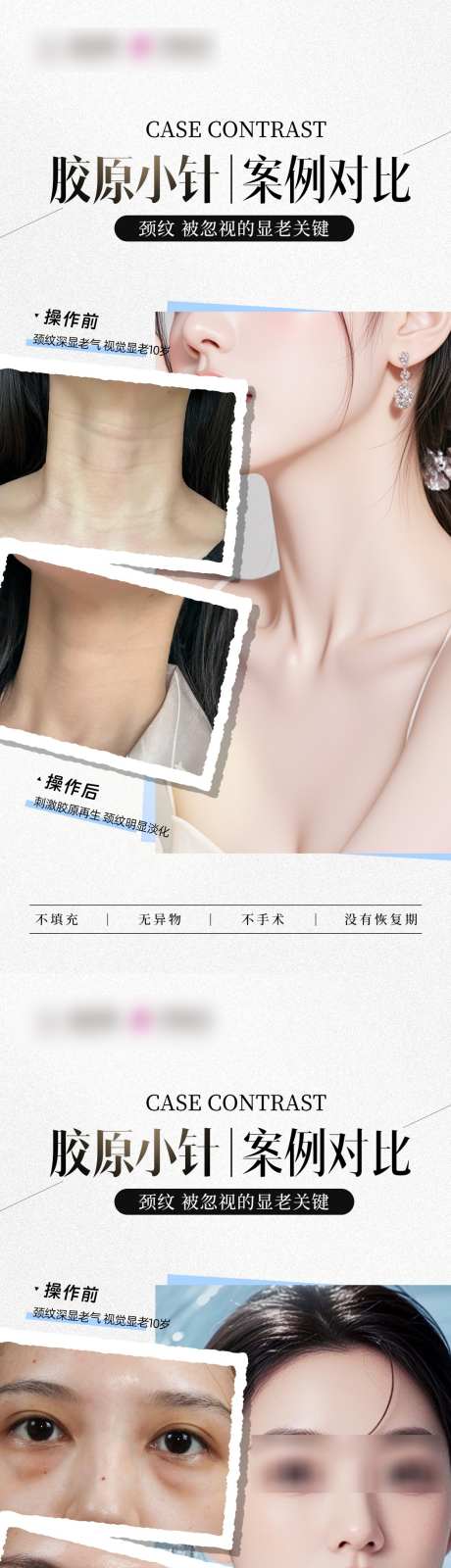 胶原小针案例_源文件下载_PSD格式_1049X4529像素-颈纹,颈部,对比-作品编号:2025081709448182-志˯设ˆ网