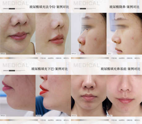 玻尿酸案例合集_源文件下载_PSD格式_2708X2348像素-下巴,隆鼻,法令纹-作品编号:2025090409517137-志ˆ设˱网
