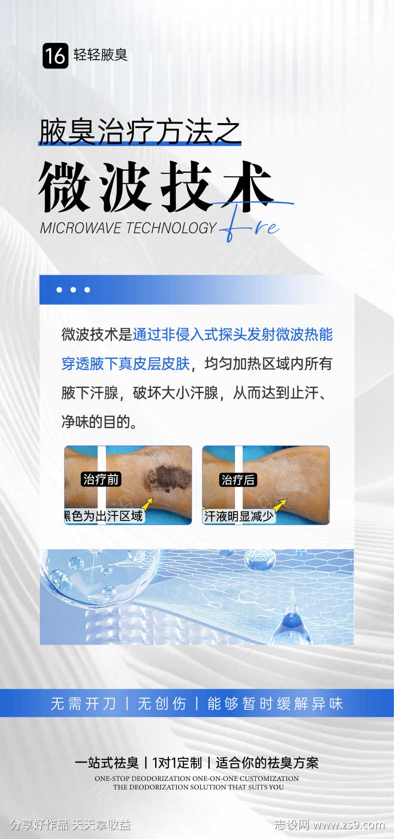 腋臭微波手术海报