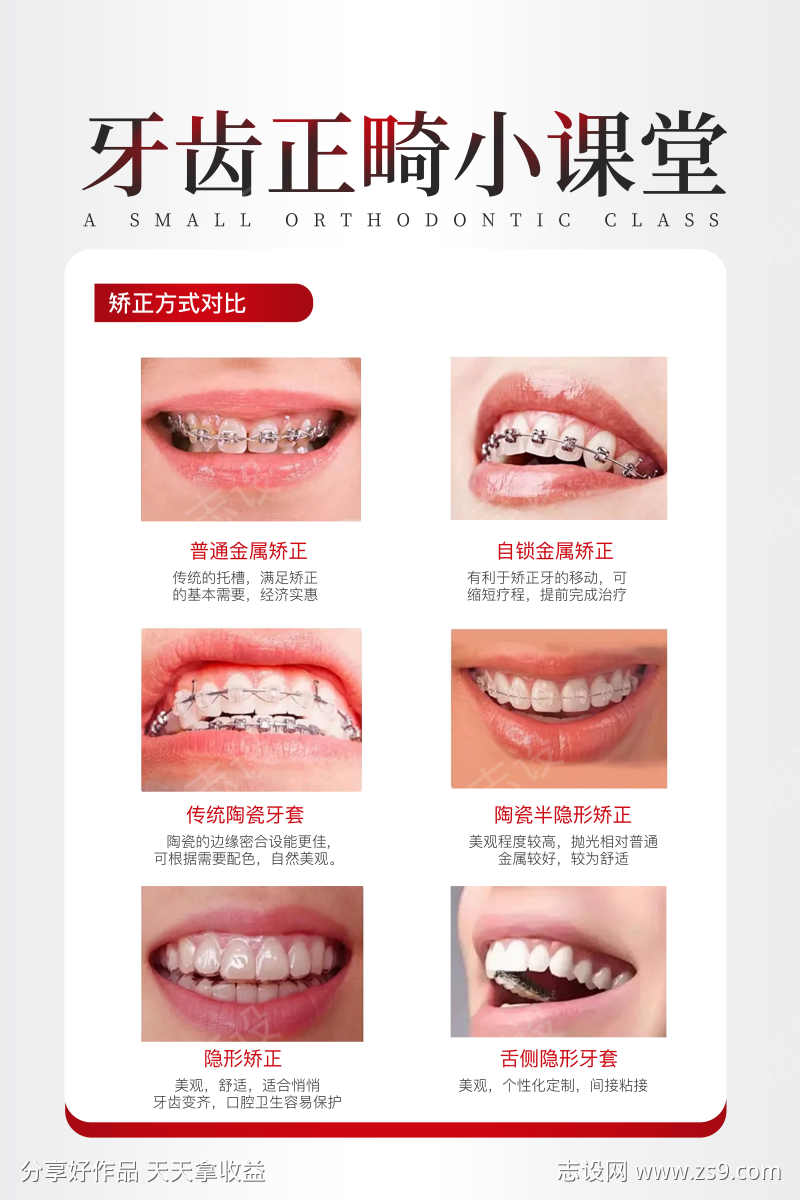 牙齿正畸科普