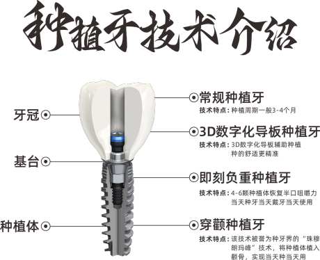 种植牙技术介绍