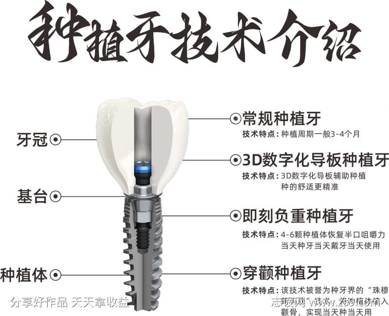 种植牙技术介绍