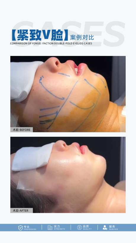 医美V脸案例海报
