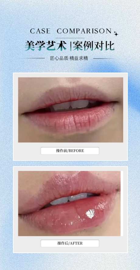 嘟嘟唇案例海报_源文件下载_PSD格式_1024X1979像素-丰唇,嘟嘟唇,案例-作品编号:2026042213392154-志,设′网