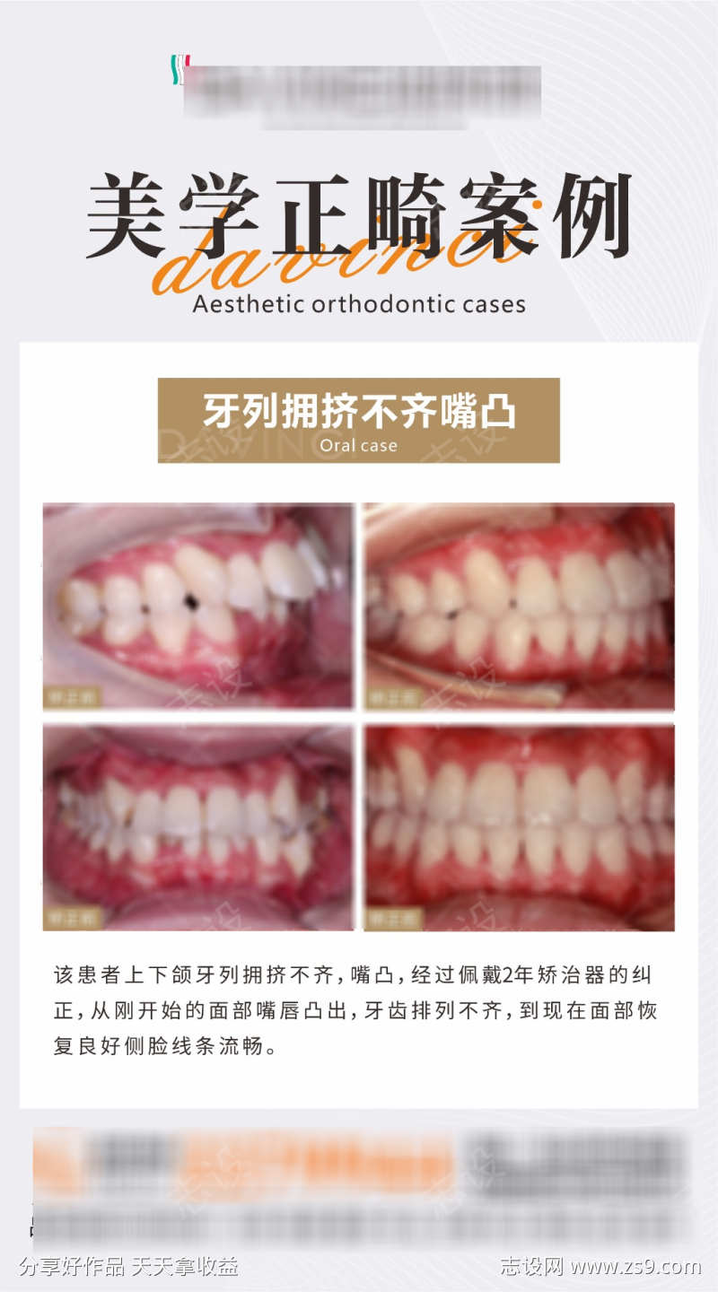 口腔正畸案例